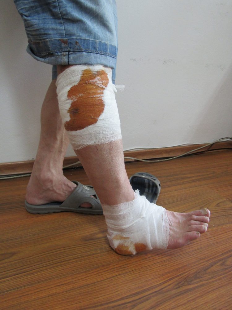 Кучета нахапаха жестоко 69-годишен мъж