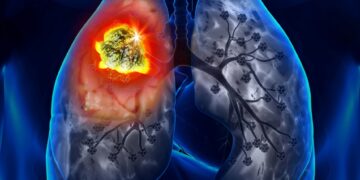 От 17-ти – безплатни прегледи за туберкулоза в “ДКЦ-1-Севлиево” ЕООД и Парахода в Габрово