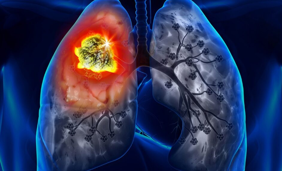 От 17-ти – безплатни прегледи за туберкулоза в “ДКЦ-1-Севлиево” ЕООД и Парахода в Габрово