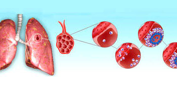 Туберкулозата е предотвратима и лечима