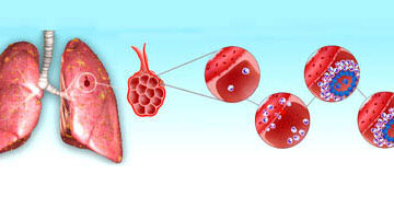 Туберкулозата е предотвратима и лечима