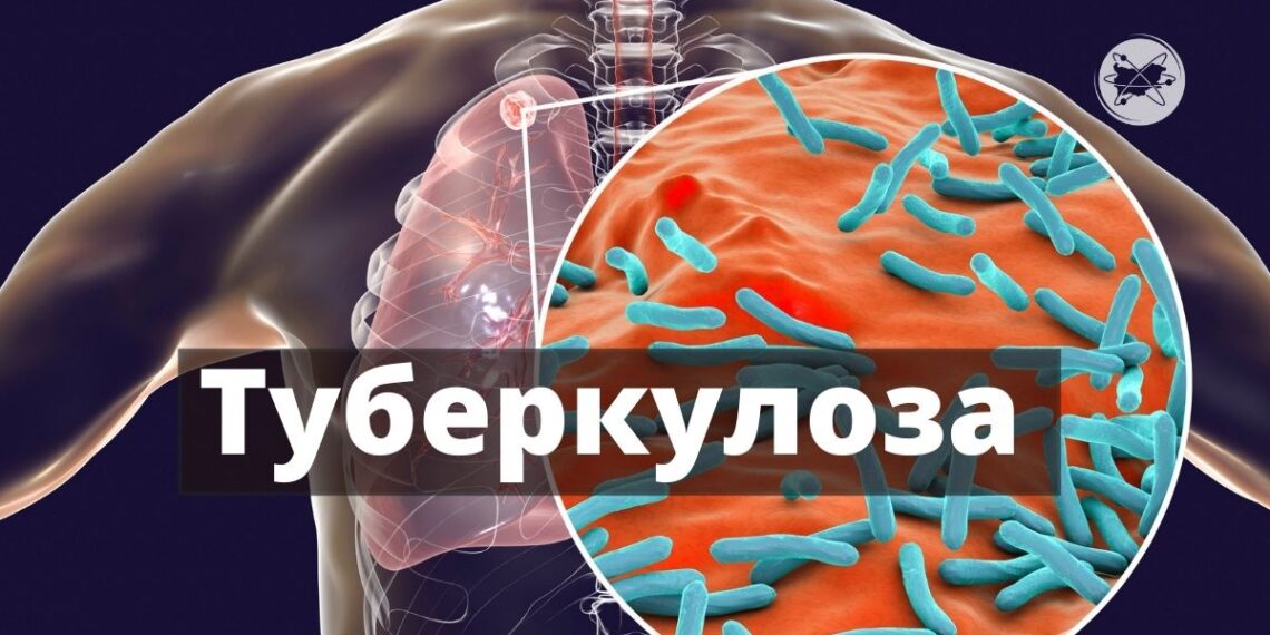 От понеделник – седмица на отворените врати за ранно откриване на туберкулоза в област Габрово