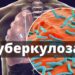 От понеделник – седмица на отворените врати за ранно откриване на туберкулоза в област Габрово